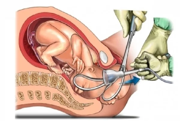 Instrumental Delivery