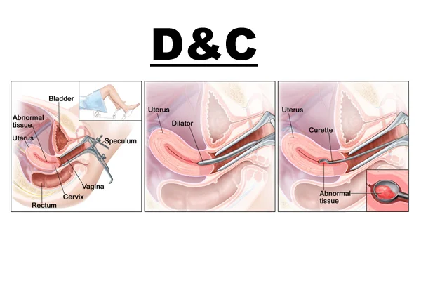 D&C
