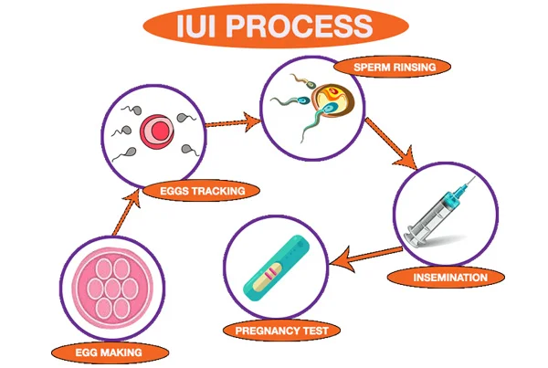 Infertility Treatment with IUI and Follicular Monitoring