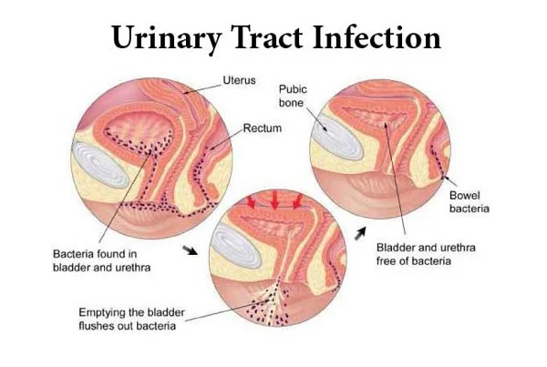 Urinary Infection Treatment